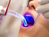 Post image for Lasers lead the way to dentistry without hated drill